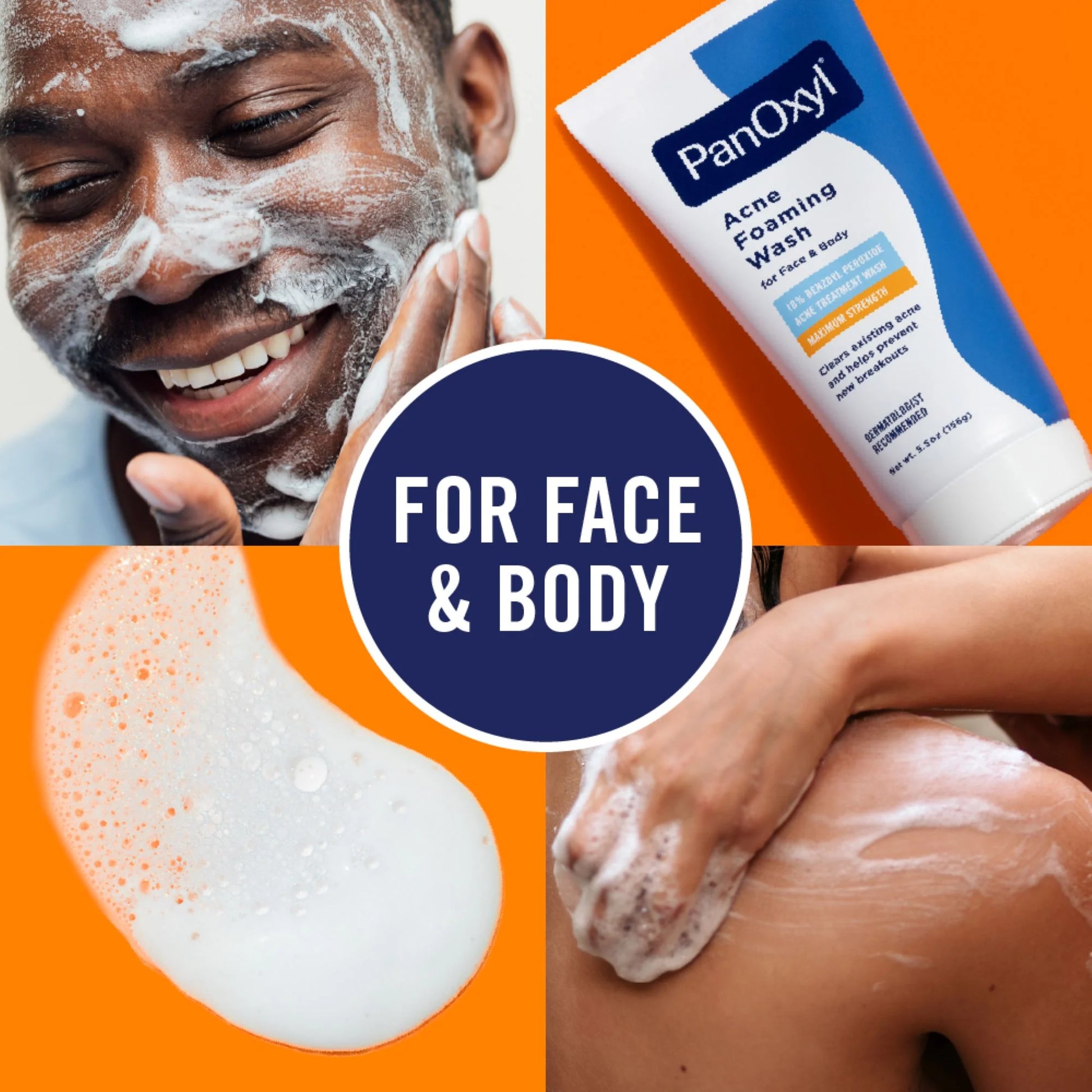 Foaming Acne Wash, 10% Benzoyl Peroxide, Maximum Strength - 5.5 Oz
